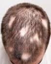alopecia areata