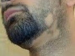 Alopecia Barbae
