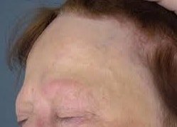 Frontal Fibrosing Alopecia (FFA)